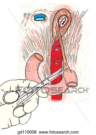 Mobilize the duodenojejunal junction by cutting through the suspensory ligament of the duodenum. View Large Illustration Stock Illustration - Mobilize the duodenojejunal junction by cutting through the suspensory ligament of the duodenum.. Fotosearch