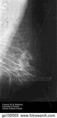 Drawing - Normal mammogram of the breast. Pectoralis major muscle is seen as white area at top left and axillary lymph node is round white structure at upper left.. Fotosearch