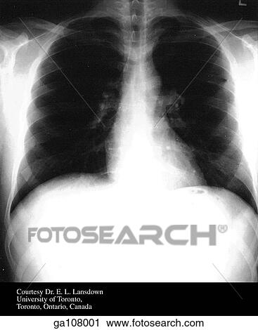 Posteroanterior projection radiograph of the chest showing normal anatomy. View Large Illustration Clip Art - Posteroanterior projection radiograph of the chest showing normal anatomy.. Fotosearch