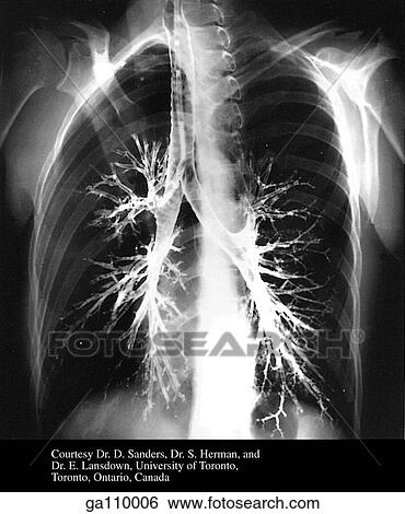 Posteroanterior, slightly oblique bronchogram of the right and left bronchial trees. View Large Illustration Stock Illustration - Posteroanterior, slightly oblique bronchogram of the right and left bronchial trees.. Fotosearch