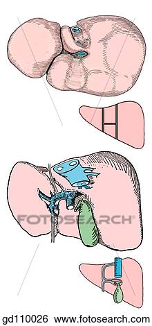 Posteroinferior view of liver. The H-shaped fissure and sulci define the four lobes of the liver (right, left, quadrate and caudate). The fissures and sulci contain certain structures: inferior vena cava, gallbladder, ligamentum venosum, ligamentum teres. View Large Illustration Stock Illustration - Posteroinferior view of liver. The H-shaped fissure and sulci define the four lobes of the liver (right, left, quadrate and caudate). The fissures and sulci contain certain structures: inferior vena cava, gallbladder, ligamentum venosum, ligamentum teres.. Fotosearch