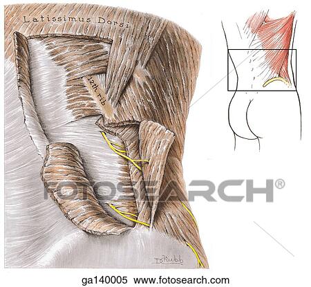 Stock Illustration - Posterolateral view of the posterior wall. External oblique muscle is incised and turned laterally, and the internal oblique muscle is incised and turned medially exposing the subcostal (T12) and iliohypogastric nerve (L1). Square in insert indicates or. Fotosearch