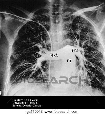 Pulmonary angiogram illustrating the pulmonary trunk (PT), right pulmonary artery (RPA) and the left pulmonary artery (LPA). View Large Illustration Drawing - Pulmonary angiogram illustrating the pulmonary trunk (PT), right pulmonary artery (RPA) and the left pulmonary artery (LPA).. Fotosearch