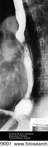 Radiograph of a lateral view of the esophagus. Esophagus seen after swallowing barium. The phrenic ampulla can be seen at the bottom. View Large Illustration Clip Art - Radiograph of a lateral view of the esophagus. Esophagus seen after swallowing barium. The phrenic ampulla can be seen at the bottom.. Fotosearch