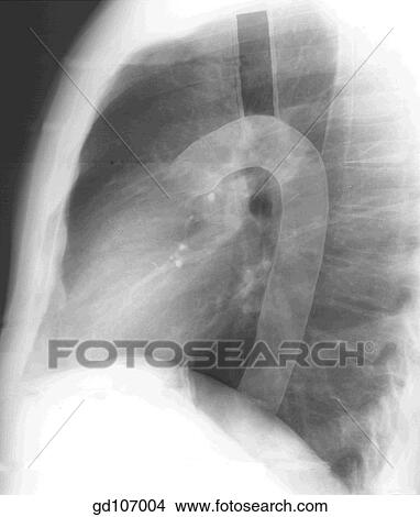 Stock Illustration - Radiograph of left lateral chest (digitally enhanced) and related anatomical structures.. Fotosearch