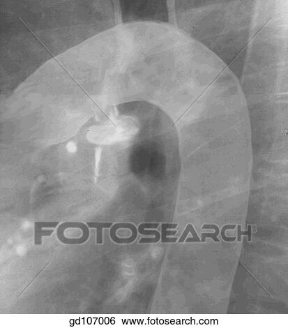 Stock Illustration - Radiograph of left lateral chest (digitally enhanced) and related anatomical structures.. Fotosearch