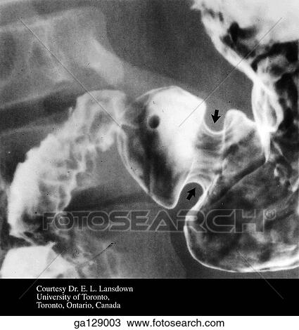 Drawing - Radiograph of pyloric region of stomach and proximal duodenum, anterior view.. Fotosearch
