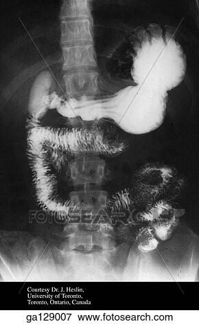 Radiograph of stomach, small intestine, and gallbladder in anterior view. View Large Illustration Stock Illustration - Radiograph of stomach, small intestine, and gallbladder in anterior view.. Fotosearch