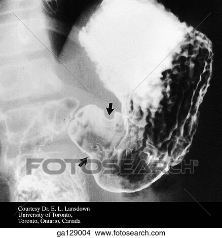 Stock Illustration - Radiograph of the stomach and small intestine after barium ingestion, anterior view. Arrows indicate a peristaltic wave.. Fotosearch