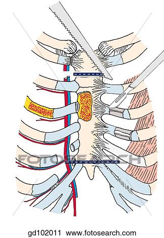 Removal of anterior thoracic wall, examination of sternocoastal joints; resection of rib segment. View Large Illustration Clip Art - Removal of anterior thoracic wall, examination of sternocoastal joints; resection of rib segment.. Fotosearch