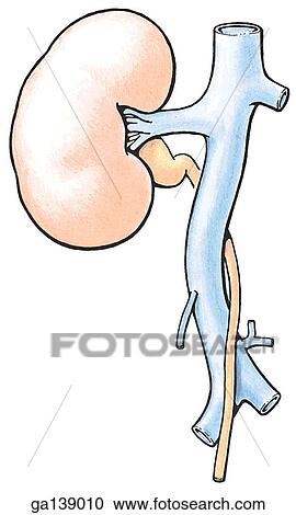 Clipart - Retrocaval ureter. The ureter courses posterior and then anterior to the inferior vena cava. . Fotosearch