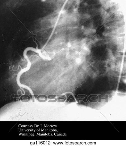 Right coronary arteriogram showing the right coronary artery stemming near the aortic valve. Orientation drawing is figure 1. 47A. View Large Illustration Drawing - Right coronary arteriogram showing the right coronary artery stemming near the aortic valve. Orientation drawing is figure 1. 47A.. Fotosearch