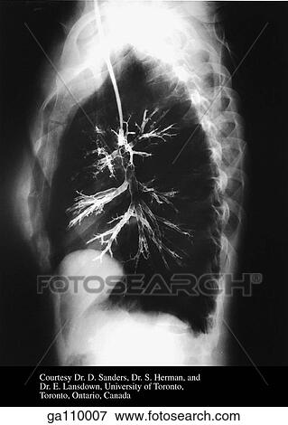 Stock Illustration - Right lateral bronchogram showing segmental bronchi.. Fotosearch