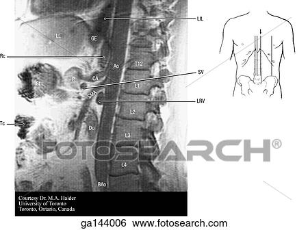 Sagittal MRI of the abdomen at the left side of the vertebral column. Small image at right shows level of scan (line B). View Large Illustration Stock Illustration - Sagittal MRI of the abdomen at the left side of the vertebral column. Small image at right shows level of scan (line B).. Fotosearch