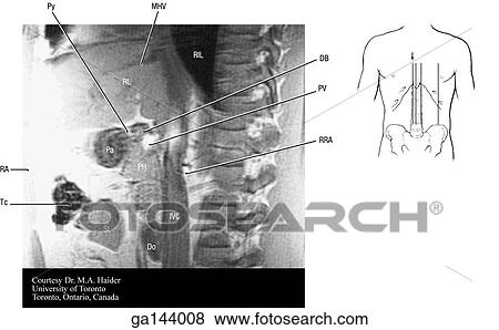 Sagittal MRI of the abdomen at the level of the left side of the vertebral column. Small image at right shows level of scan (line D). View Large Illustration Stock Illustration - Sagittal MRI of the abdomen at the level of the left side of the vertebral column. Small image at right shows level of scan (line D).. Fotosearch