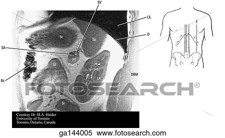 Sagittal MRI of the abdomen through the left kidney. Small image at right shows level of scan (line A). View Large Illustration Stock Illustration - Sagittal MRI of the abdomen through the left kidney. Small image at right shows level of scan (line A).. Fotosearch