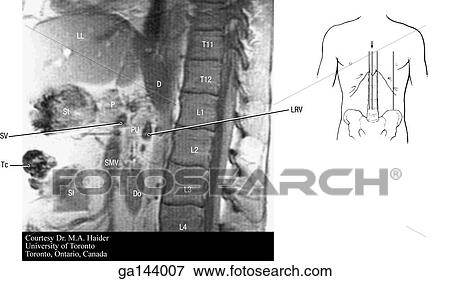 Stock Illustration - Sagittal MRI of the abdomen through the level of the vertebral column. Small image at right shows level of scan (line C).. Fotosearch