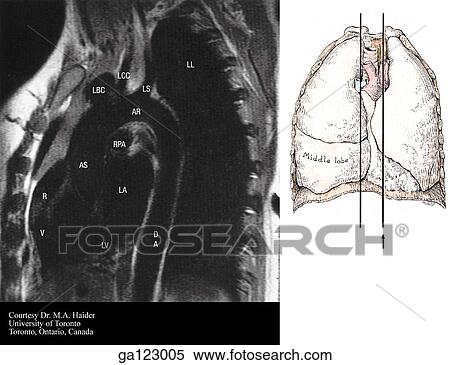 Stock Illustration - Sagittal MRI of the thorax at the level of the descending aorta. The image to the right indicates the level of each sagittal MRI.. Fotosearch