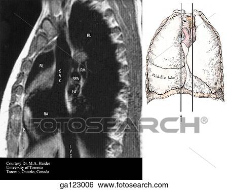 Stock Illustration - Sagittal MRI of the thorax at the level of the superior vena cava. The image to the right indicates the level of each sagittal MRI.. Fotosearch