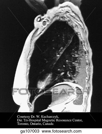 Drawing - Sagittal view MRI showing the anatomical relationship of the pleura and lungs with the surrounding thoracic and abdominal structures.. Fotosearch