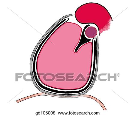 Schema of pericardium and heart in sagittal section. Pulmonary trunk with subsequent bifurcation into right and left pulmonary arteries. View Large Illustration Stock Illustration - Schema of pericardium and heart in sagittal section. Pulmonary trunk with subsequent bifurcation into right and left pulmonary arteries.. Fotosearch
