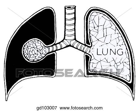 Schema of pleural membranes (pleurae) and pleural cavity. View Large Illustration Stock Illustration - Schema of pleural membranes (pleurae) and pleural cavity.. Fotosearch
