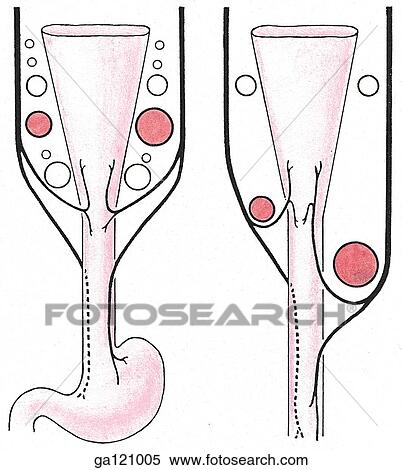 Schematic illustration demonstrating embryonic development of asymmetrical courses of right and left recurrent laryngeal nerve. View Large Illustration Stock Illustration - Schematic illustration demonstrating embryonic development of asymmetrical courses of right and left recurrent laryngeal nerve.. Fotosearch