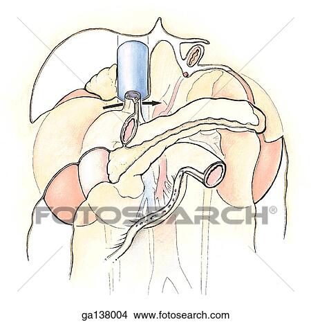 Schematic illustration of the duodenum and pancreas in situ with the liver, stomach, colon and small intestines removed. The posterior abdominal area and corresponding "bare areas" are illustrated. View Large Illustration Stock Illustration - Schematic illustration of the duodenum and pancreas in situ with the liver, stomach, colon and small intestines removed. The posterior abdominal area and corresponding "bare areas" are illustrated.. Fotosearch