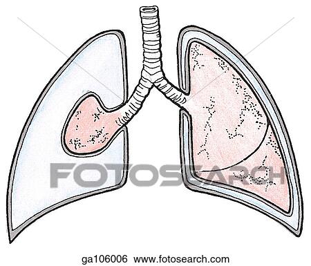 Stock Illustration - Schematic representation of a right collapsed lung and an inflated left lung.. Fotosearch