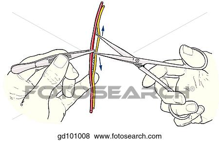 Stock Illustration - Scissors technique: separating delicate structures.. Fotosearch