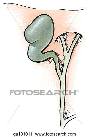 Clip Art - Simple drawing of a folded gallbladder.. Fotosearch