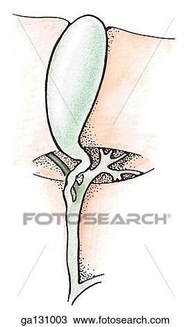 Drawing - Simple drawing showing an accessory hepatic duct joining common hepatic duct near the cystic duct.. Fotosearch