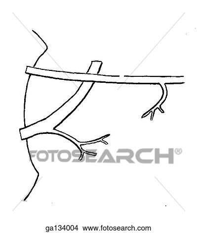 Stock Illustration - Simple line drawing of a common variation of pancreatic duct where a persisting primitive dorsal duct is shown unconnected to the primitive ventral duct.. Fotosearch