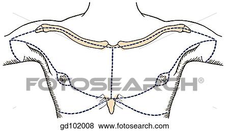 Skin incisions for dissection of thoracic wall. View Large Illustration Stock Illustration - Skin incisions for dissection of thoracic wall.. Fotosearch