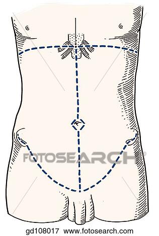 Skin incisions. View Large Illustration Stock Illustration - Skin incisions.. Fotosearch