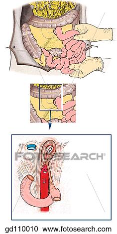 The duodenojejunal junction is suspended by the suspensory ligament of the duodenum (ligament of Treitz). View Large Illustration Clipart - The duodenojejunal junction is suspended by the suspensory ligament of the duodenum (ligament of Treitz).. Fotosearch