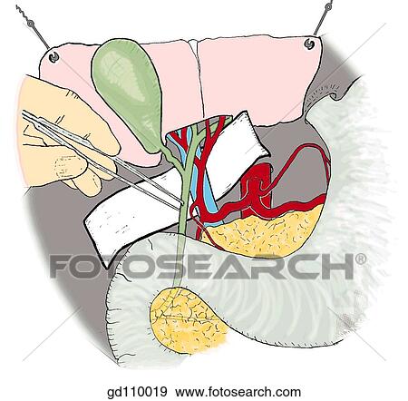 The main structures contained in the hepatoduodenal ligament: bile passages, hepatic artery and portal vein. The forceps are pulling on the bile duct. View Large Illustration Stock Illustration - The main structures contained in the hepatoduodenal ligament: bile passages, hepatic artery and portal vein. The forceps are pulling on the bile duct.. Fotosearch