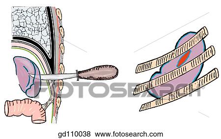 Topographic relations of the spleen. A knife pushed through the 9th intercostal space, just posterior to the midaxillary line, will penetrate the pleural cavity, diaphragm, peritoneal cavity and spleen. View Large Illustration Stock Illustration - Topographic relations of the spleen. A knife pushed through the 9th intercostal space, just posterior to the midaxillary line, will penetrate the pleural cavity, diaphragm, peritoneal cavity and spleen.. Fotosearch