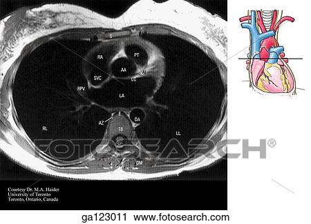Transverse, or horizontal (axial), MRI of the thorax at the level of the upper atria and T8. The image to the right indicates the level of each transverse MRI. View Large Illustration Clip Art - Transverse, or horizontal (axial), MRI of the thorax at the level of the upper atria and T8. The image to the right indicates the level of each transverse MRI.. Fotosearch