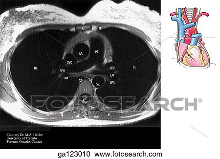 Clipart - Transverse, or horizontal (axial), MRI of the thorax at the level of the pulmonary trunk and T7. The image to the right indicates the level of each transverse MRI.. Fotosearch