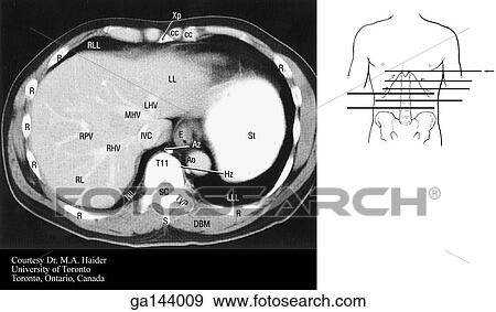 Stock Illustration - Transverse or horizontal (axial) MRI of the abdomen at the level of the xiphoid process and T11. Image at bottom illustrates level of scan (line A).. Fotosearch