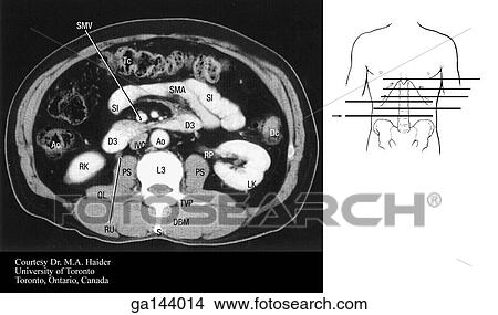 Stock Illustration - Transverse or horizontal (axial) MRI of the abdomen at the level of the lower L3. Image at bottom illustrates level of scan (line F).. Fotosearch