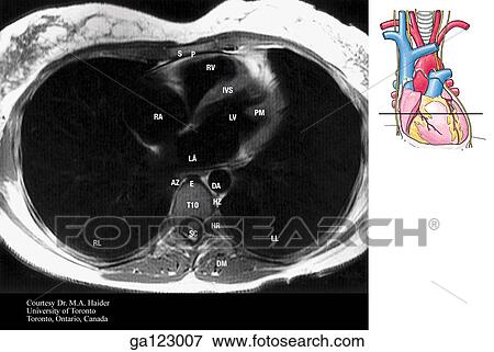 Transverse, or horizontal (axial), MRI of the thorax at the level of the lower heart and T9. The image to the right indicates the level of each transverse MRI. View Large Illustration Stock Illustration - Transverse, or horizontal (axial), MRI of the thorax at the level of the lower heart and T9. The image to the right indicates the level of each transverse MRI.. Fotosearch