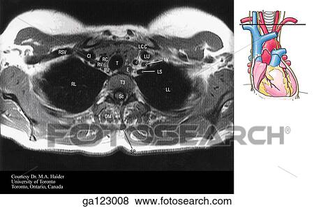 Transverse, or horizontal (axial), MRI of the thorax at the level of the right brachiocephalic artery bifurcation and T3. The image to the right indicates the level of each transverse MRI. View Large Illustration Stock Illustration - Transverse, or horizontal (axial), MRI of the thorax at the level of the right brachiocephalic artery bifurcation and T3. The image to the right indicates the level of each transverse MRI.. Fotosearch
