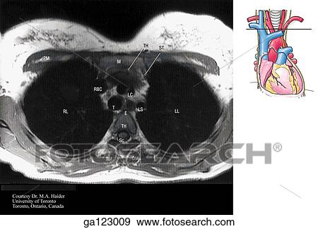 Transverse, or horizontal (axial), MRI of the thorax at the level of the right brachiocephalic vein bifurcation and T4. The image to the right indicates the level of each transverse MRI. View Large Illustration Stock Illustration - Transverse, or horizontal (axial), MRI of the thorax at the level of the right brachiocephalic vein bifurcation and T4. The image to the right indicates the level of each transverse MRI.. Fotosearch