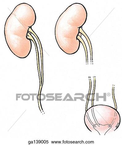 Stock Illustration - Two simple images showing examples of duplicate, or bifid, ureters. Left image shows an example of incomplete bifid ureters, the right image is an example of complete bifid. These can be unilateral or bilateral.. Fotosearch