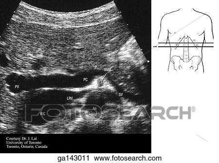 Ultrasound of the abdomen at the level of the portal confluence and L1. Small line drawing shows level of unltarsound (line C). View Large Illustration Clip Art - Ultrasound of the abdomen at the level of the portal confluence and L1. Small line drawing shows level of unltarsound (line C).. Fotosearch