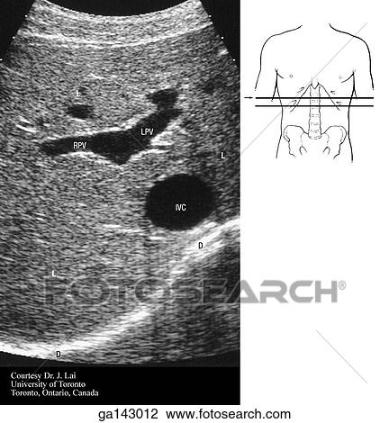 Drawing - Ultrasound of the abdomen at the level of the liver and T12. Small line drawing shows level of unltarsound (line B).. Fotosearch