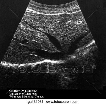 Clip Art - Ultrasound scan of hepatic veins comparable to Fig. 2. 47. Transducer was placed under the costal margin, angled toward the diaphragm to show left and middle branches of hepatic veins.. Fotosearch