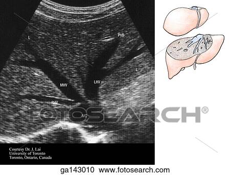 Ultrasound scan of hepatic veins. Transducer was placed under the costal margin, angled toward the diaphragm to show left and middle branches of hepatic veins. Small orientation drawing of the liver at right indicates level of scan. View Large Illustration Clipart - Ultrasound scan of hepatic veins. Transducer was placed under the costal margin, angled toward the diaphragm to show left and middle branches of hepatic veins. Small orientation drawing of the liver at right indicates level of scan.. Fotosearch